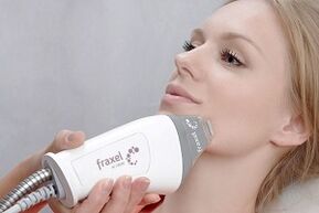 суштина поступка фракционог подмлађивања коже лица